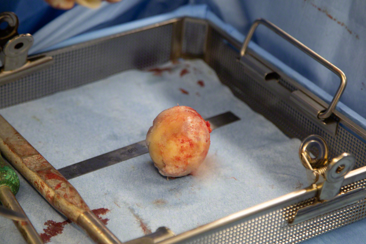 La cabeza del f&eacute;mur extra&iacute;da durante la operaci&oacute;n. Deber&iacute;a presentar un color blanco perla, pero va amarilleando a medida que se deteriora. A mi esposa se le hab&iacute;a desgastado tanto el cart&iacute;lago que ya sal&iacute;a el hueso por debajo. &ldquo;Deb&iacute;a de dolerle al andar porque el hueso tiene nervios&rdquo;, apunta el doctor Matsubara.