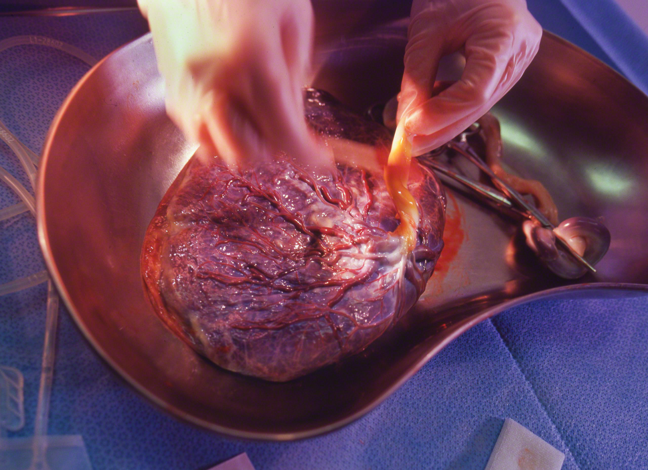 Le sang du cordon qui reste &agrave; l'int&eacute;rieur du cordon ombilical et du placenta est riche en cellules souches participant &agrave; la formation du sang, et il a de nombreux usages en m&eacute;decine r&eacute;g&eacute;n&eacute;rative.