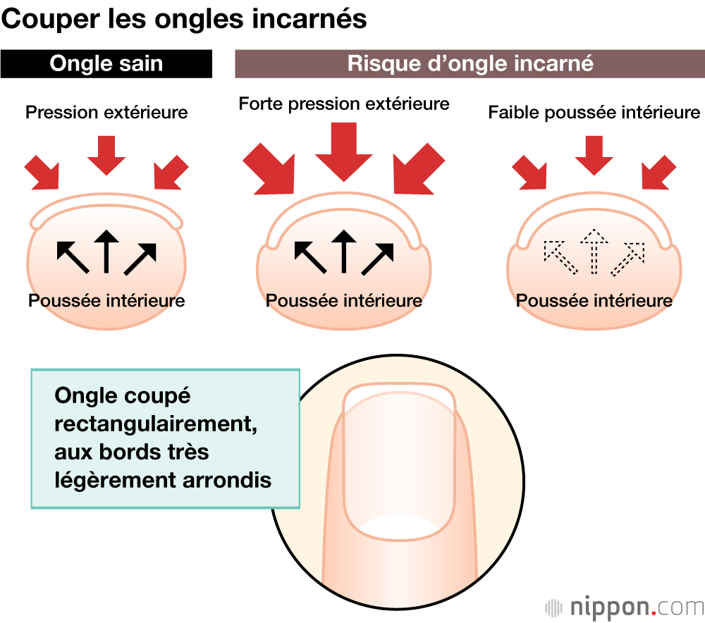 Couper les ongles incarnés