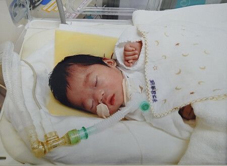 Le bébé né sous césarienne d'urgence