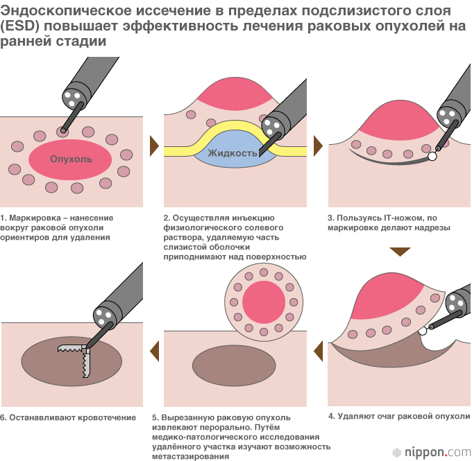 Операция удаления опухоли желудка. Эндоскопическая резекция слизистой EMR. Эндоскопическая резекция слизистой пищевода. Эндоскопическая диссекция опухоли ЖКТ.